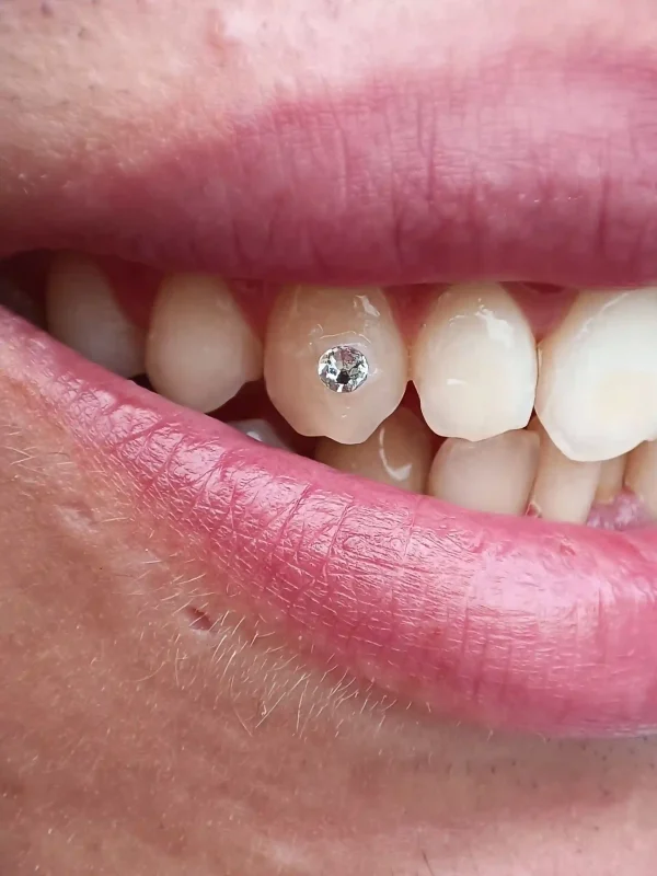 plano detalle de tooth gem